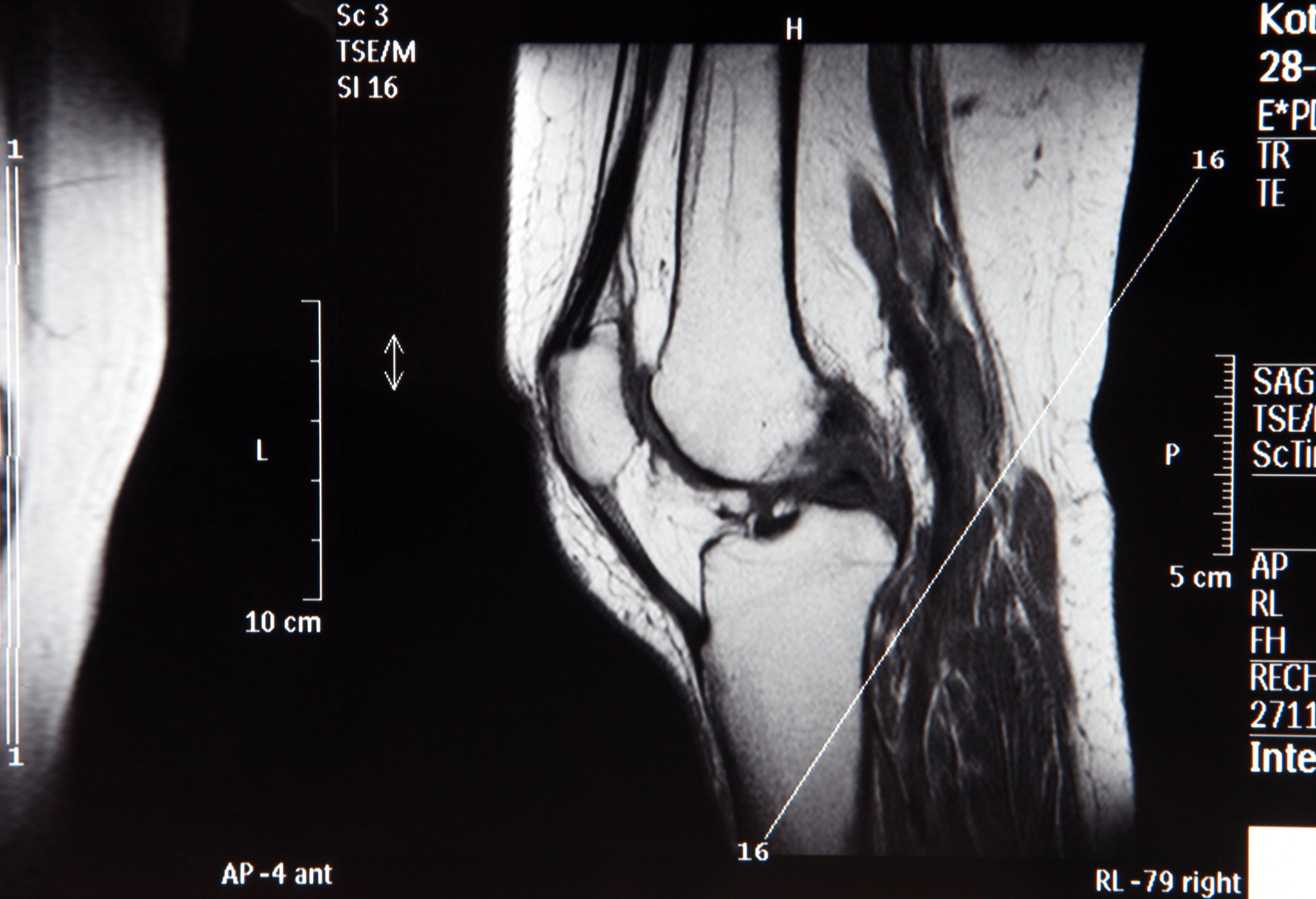 Radiografía del hueso de la rodilla.