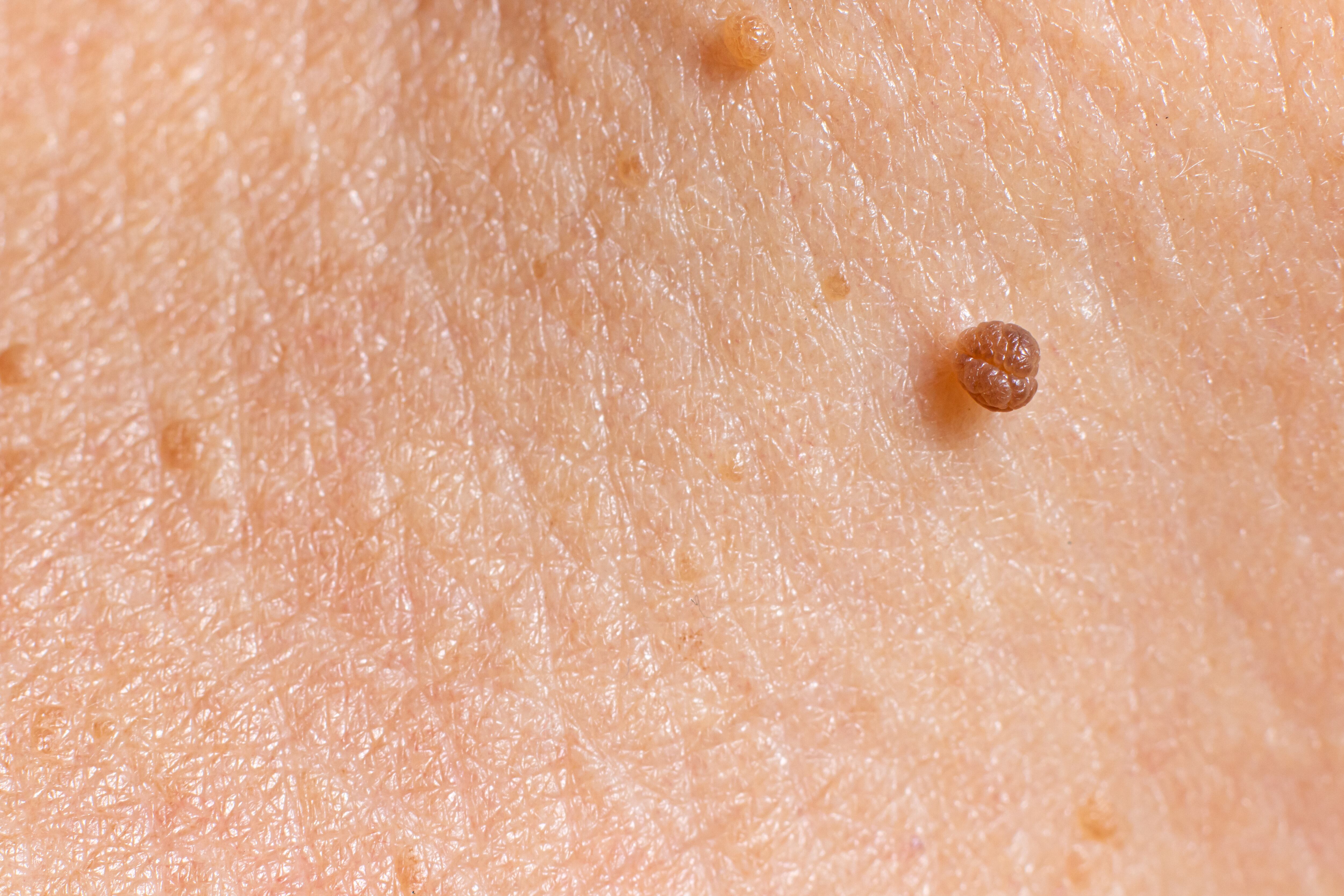 Papilloma on human skin - benign tumor in the form of mole, nevus, tumor. Papillomatosis