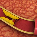 Los niveles altos del 'colesterol malo' (LDL) incrementa el riesgo de padecer enfermedades cardíacas, diabetes o renales. Foto: Getty Images.