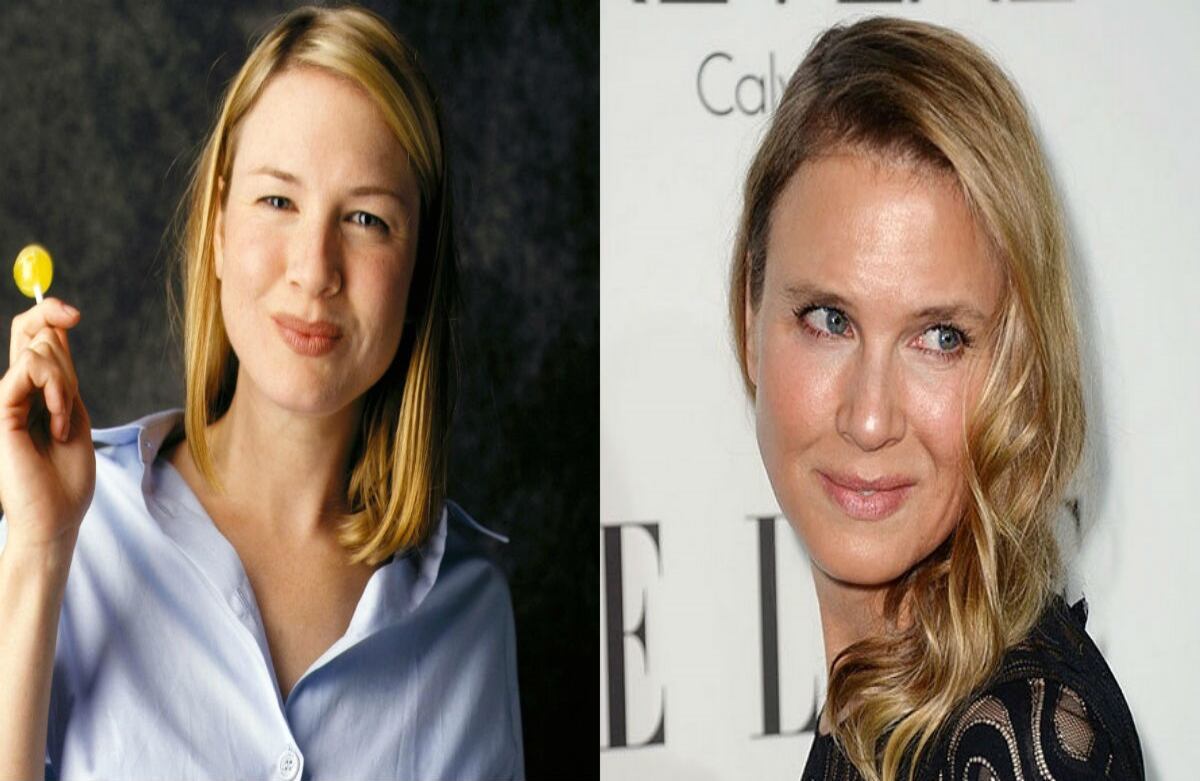 Cirujanos consultados por los medios dicen que la actriz Renee Zellweger se podría haber hecho un implante de mentón y aplicado bótox, además de una blefaroplastia para levantar los párpados.