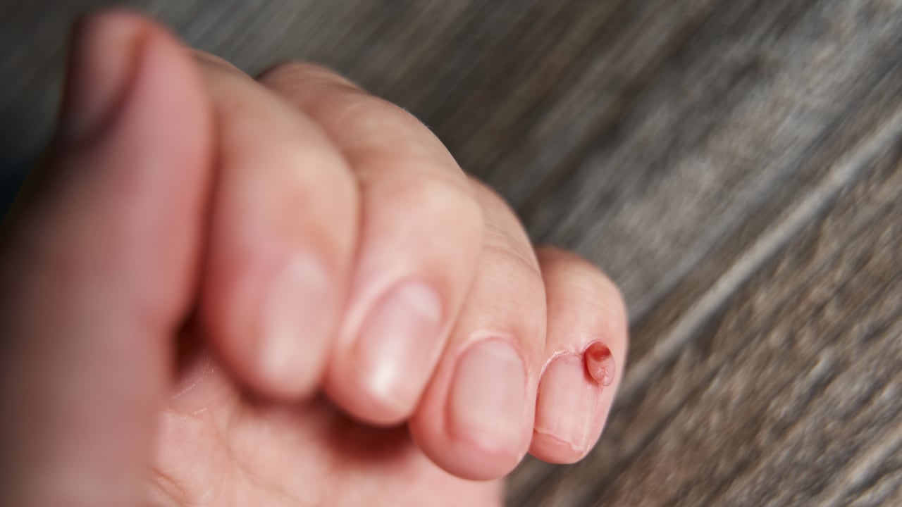tumor uñas
