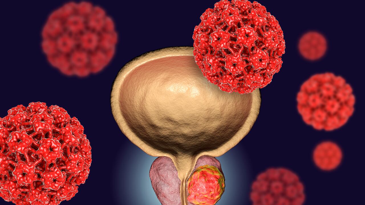 Cáncer de próstata resistente a la castración.