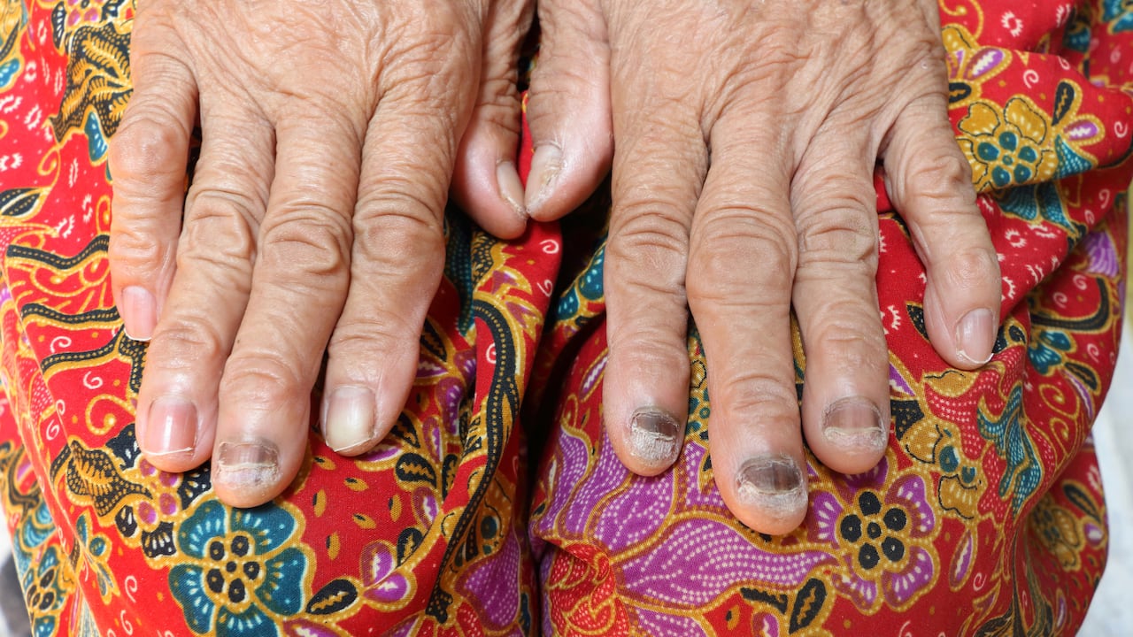 ¿Cómo curar los hongos de las uñas de las manos con remedios caseros?