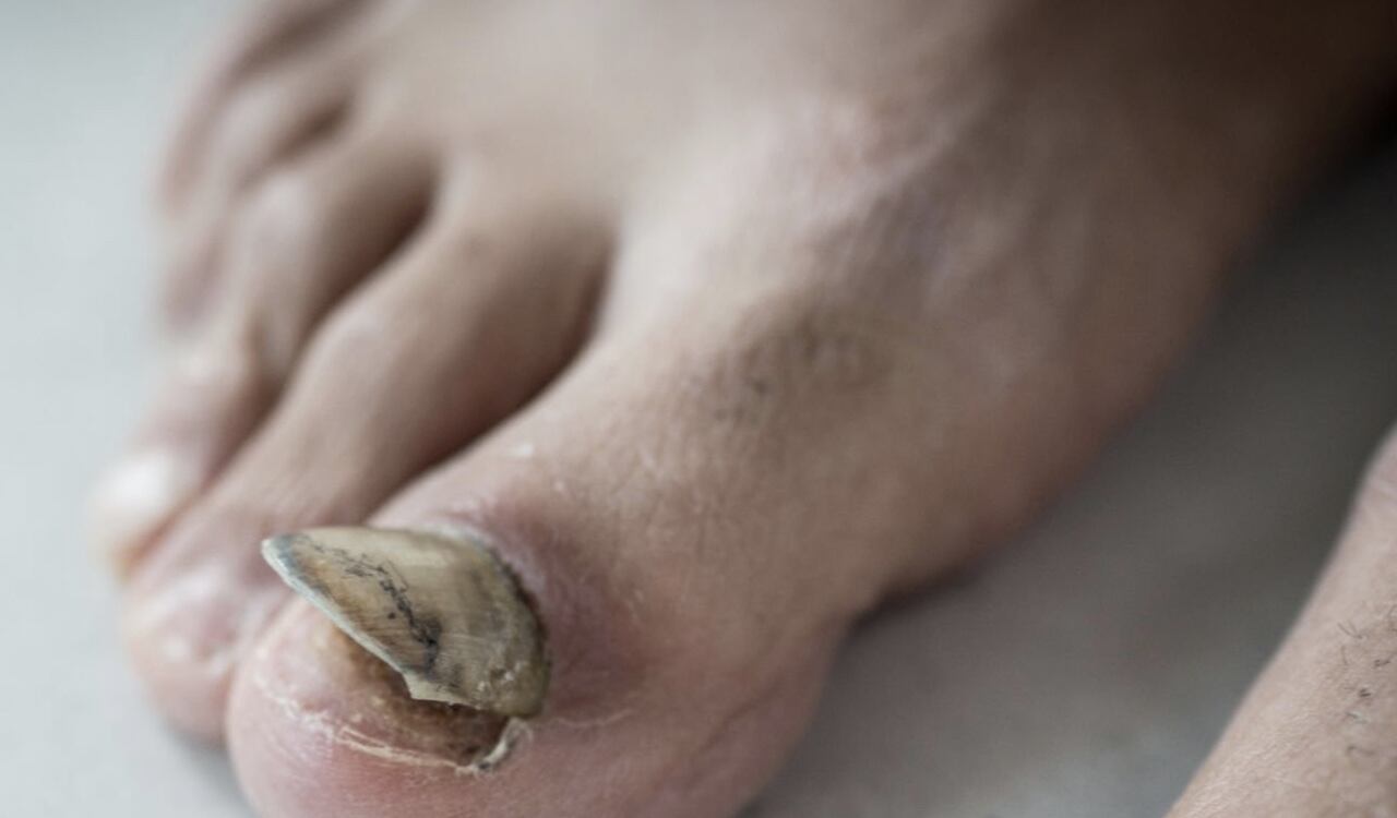 Los hongos en las uñas pueden ser tratados con varios medicamentos caseros.