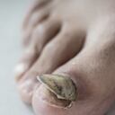 Los hongos en las uñas pueden ser tratados con varios medicamentos caseros.