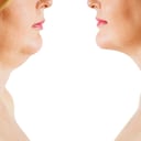 Detrás de la aparición de la papada pueden estar algunas enfermedades.