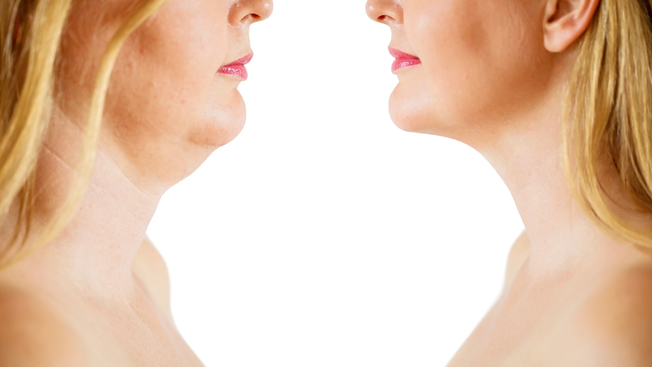 Detrás de la aparición de la papada pueden estar algunas enfermedades.