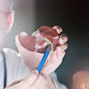 Cálculos biliares, crecen en la vesícula.