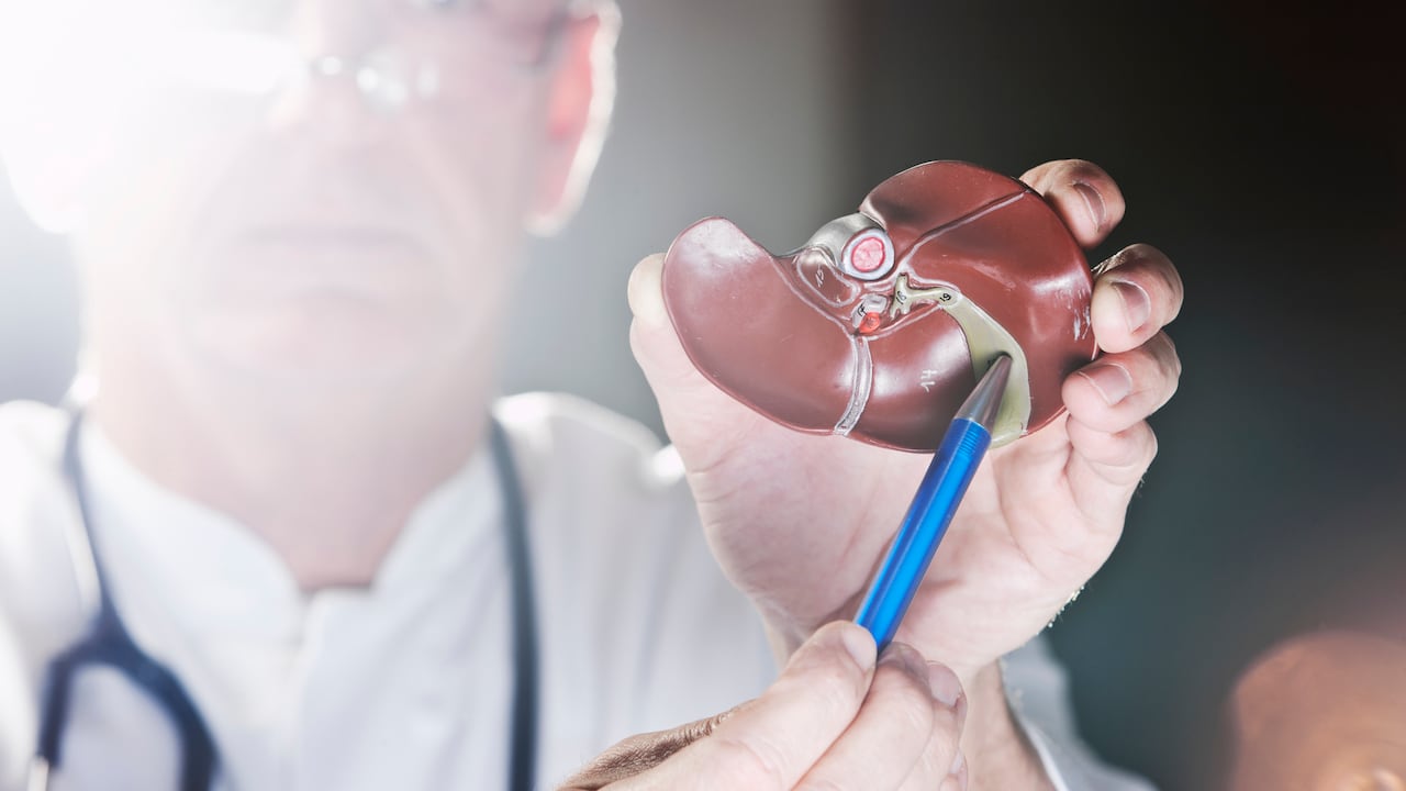 Los cálculos biliares se forman en la vesícula.