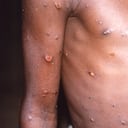 Sólo hay una autorizada por la Agencia Europea del Medicamento (EMA).