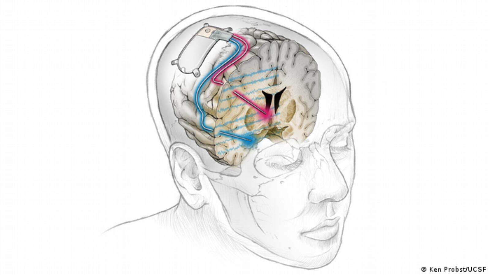 La depresión severa resistente a los tratamientos puede mejorar de forma sostenida gracias a un nuevo enfoque de medicina de precisión
