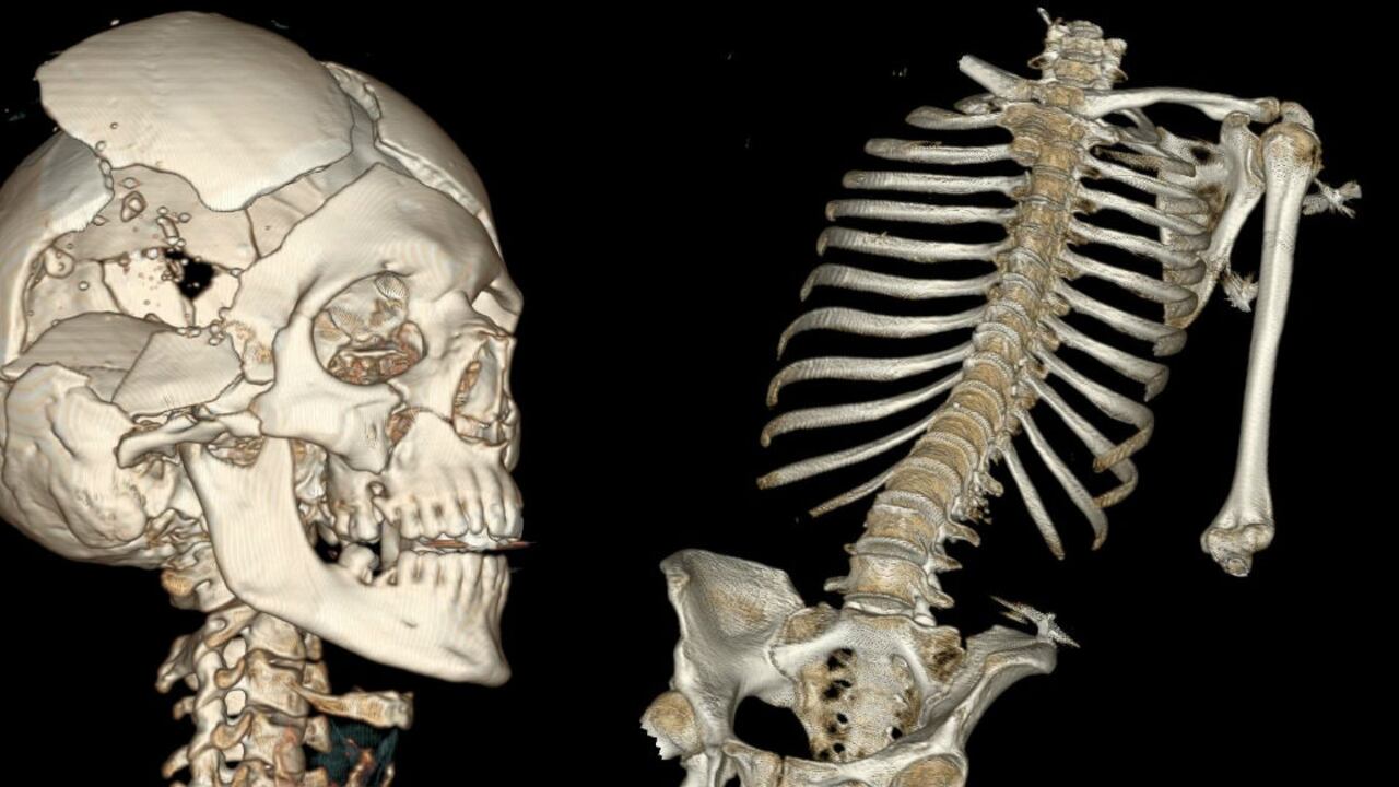 Imágenes digitales de una 'virtopsia'