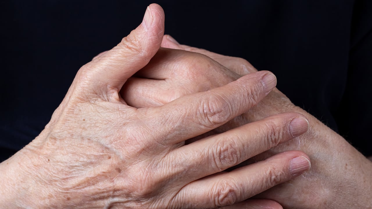Las arrugas en las manos pueden producirse por exposición al Sol o signos de la edad.