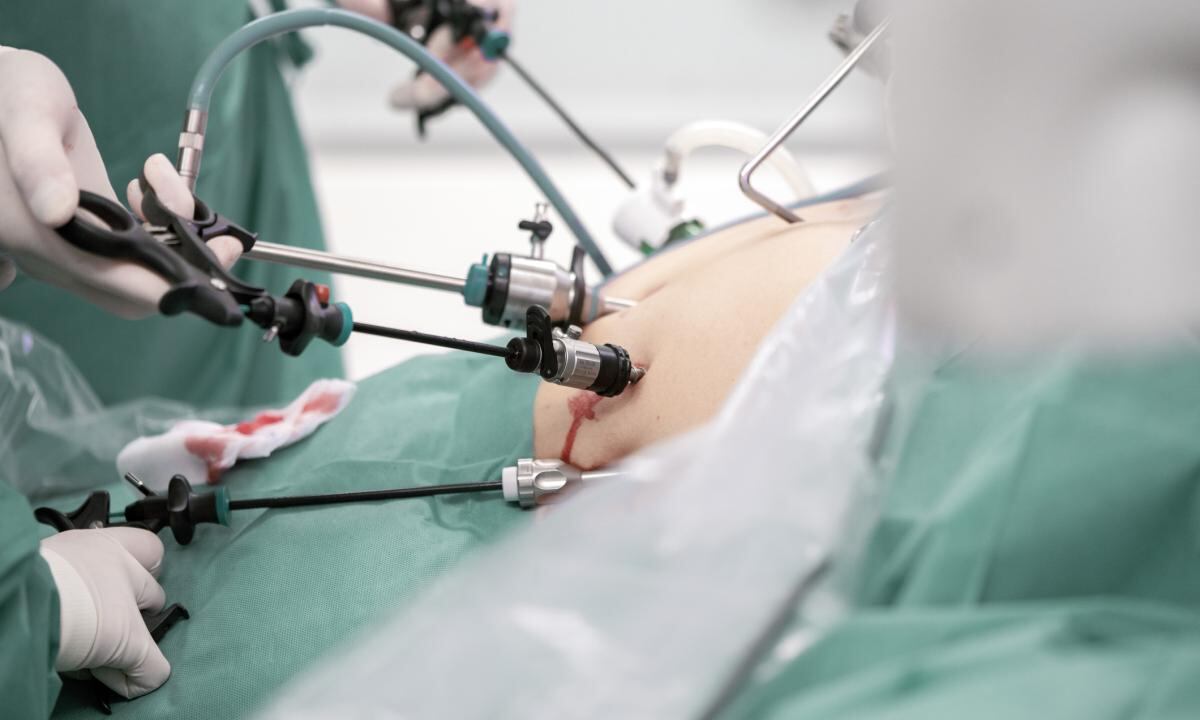 ¿Qué tan recomendable es el bypass gástrico?