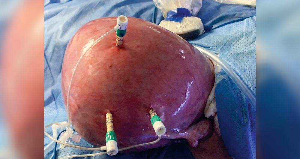 Operada sin salir del útero _2