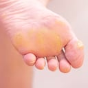 Los callos en los pies se pueden presentar por el uso de calzado apretado.