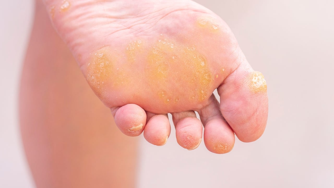 Los callos son más frecuentes en la parte lateral o superior de los dedos y pueden ser dolorosos, especialmente, cuando se presionan o se tocan.