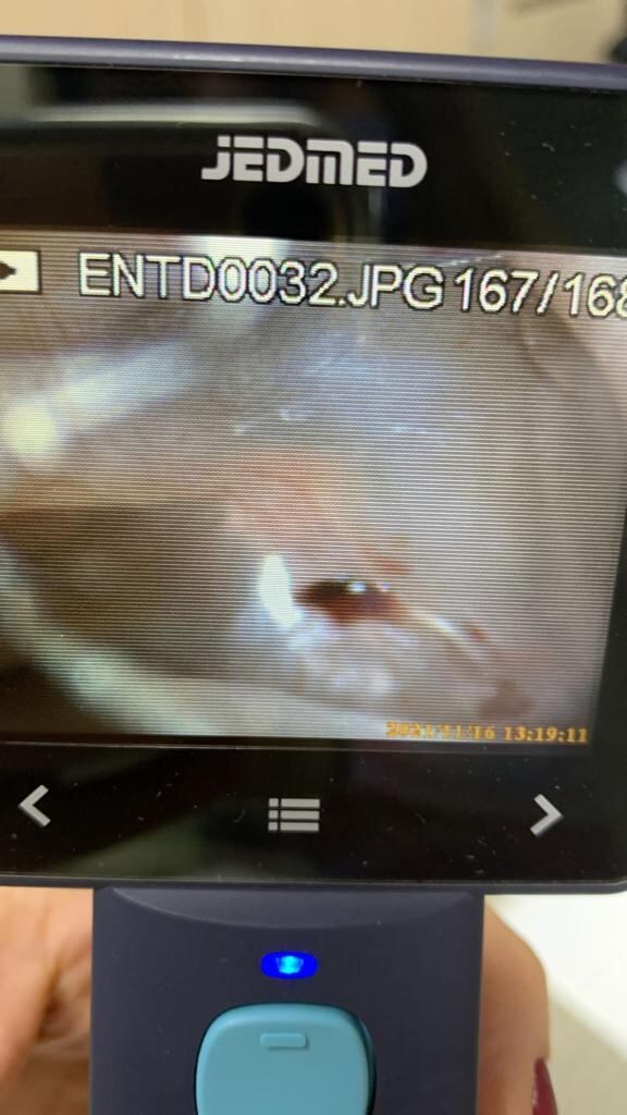 Tímpano de María Paula Pizarro prueba de la agresión de la que fue víctima.