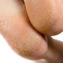 Los callos en los pies pueden ser dolorosos.