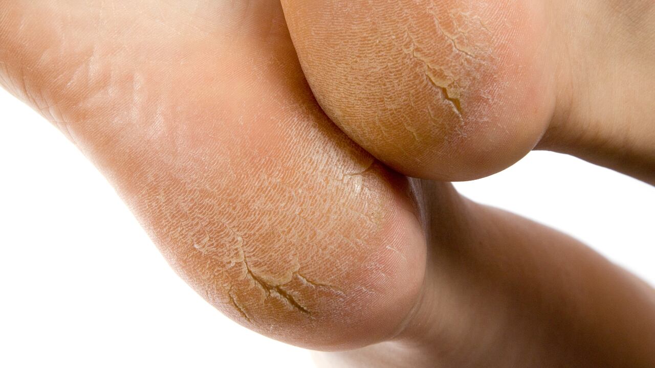 Los callos en los pies pueden ser dolorosos.