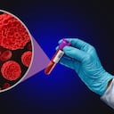 Algunos pacientes desarrollan mieloma tras años de vivir con una condición previa llamada gammapatía monoclonal de significado incierto (MGUS) o su variante mieloma indolente (smoldering myeloma).
