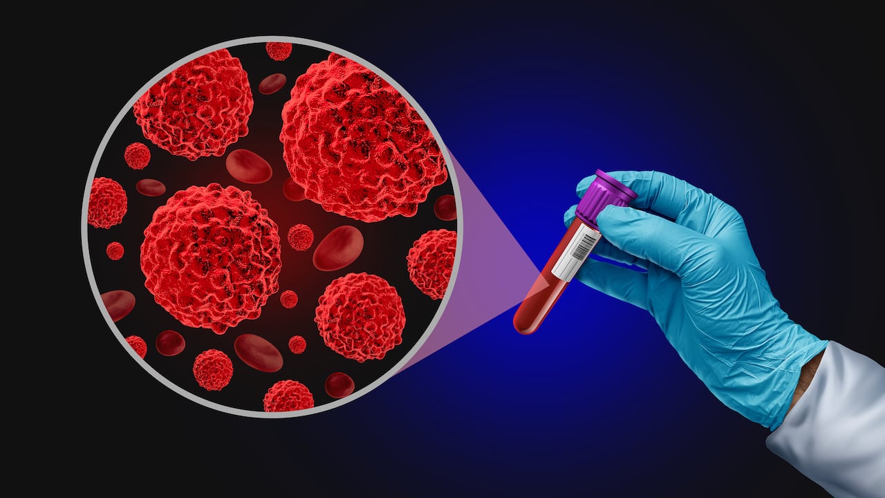 Entre los posibles factores de riesgo para el mieloma múltiple están los genéticos, de género, étnicos, ambientales y biológicos aumentan el riesgo de desarrollarlo.