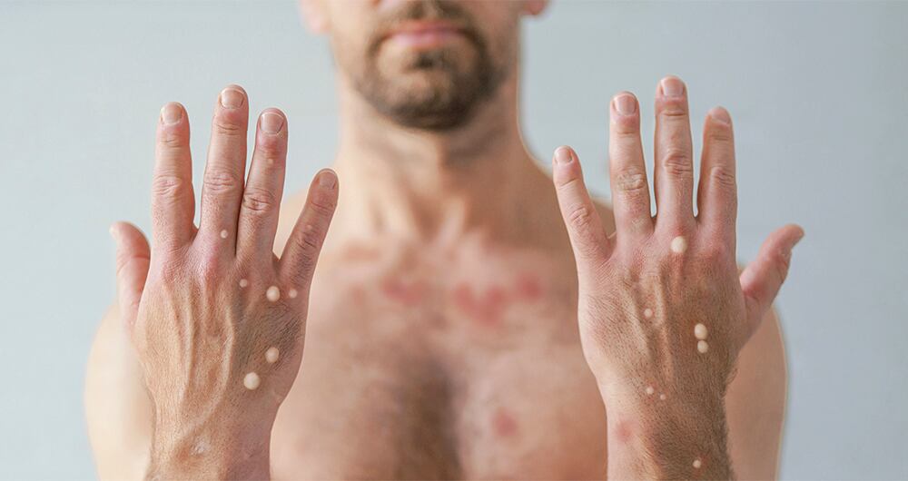 El síntoma más característico de la viruela del mono son las lesiones cutáneas que aparecen algunos días después del contagio, y son el principal foco de infección.