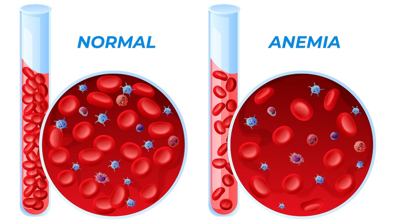 Anemia