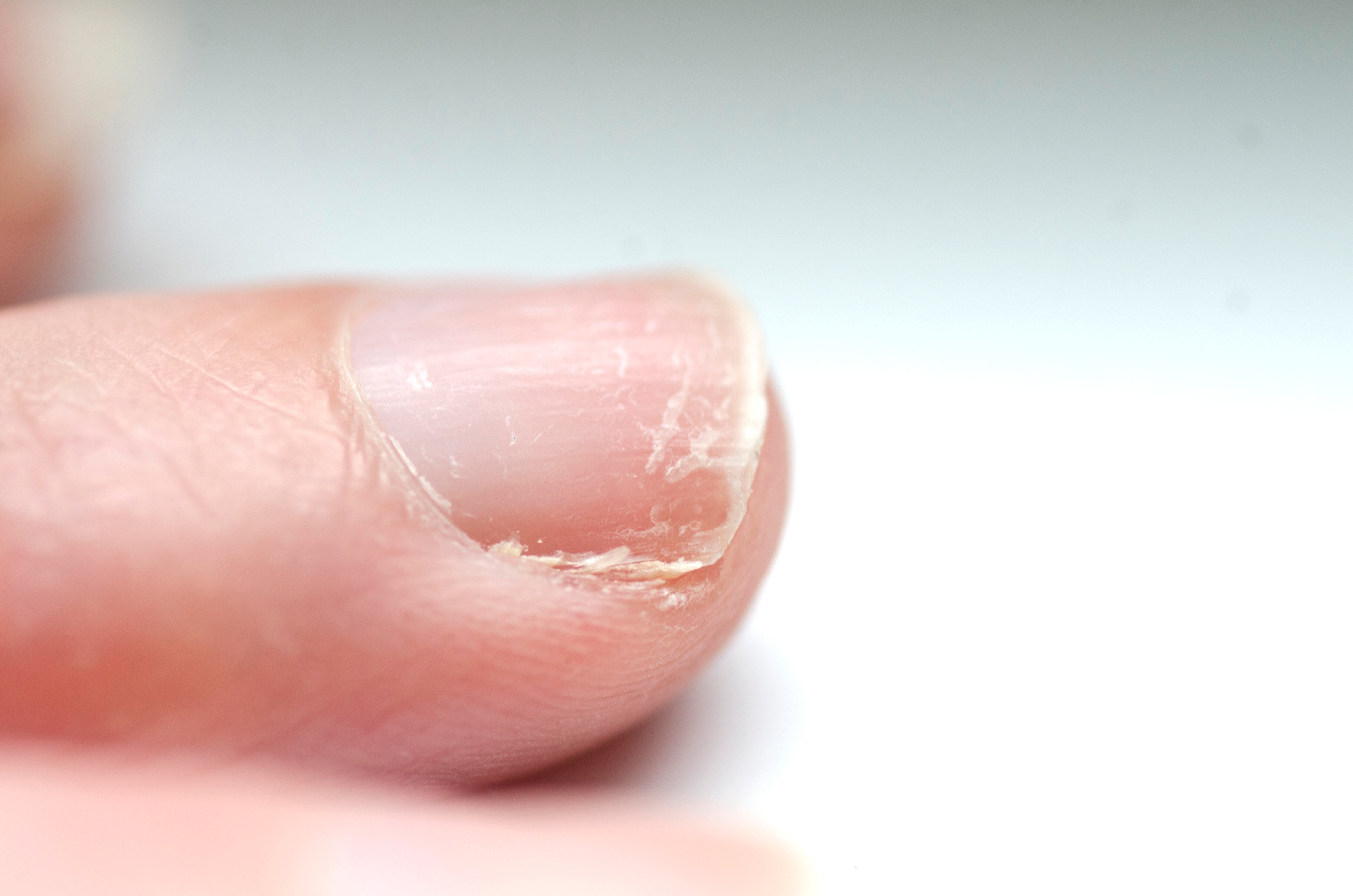 Las uñas quebradizas puede deberse a una mala alimentación.