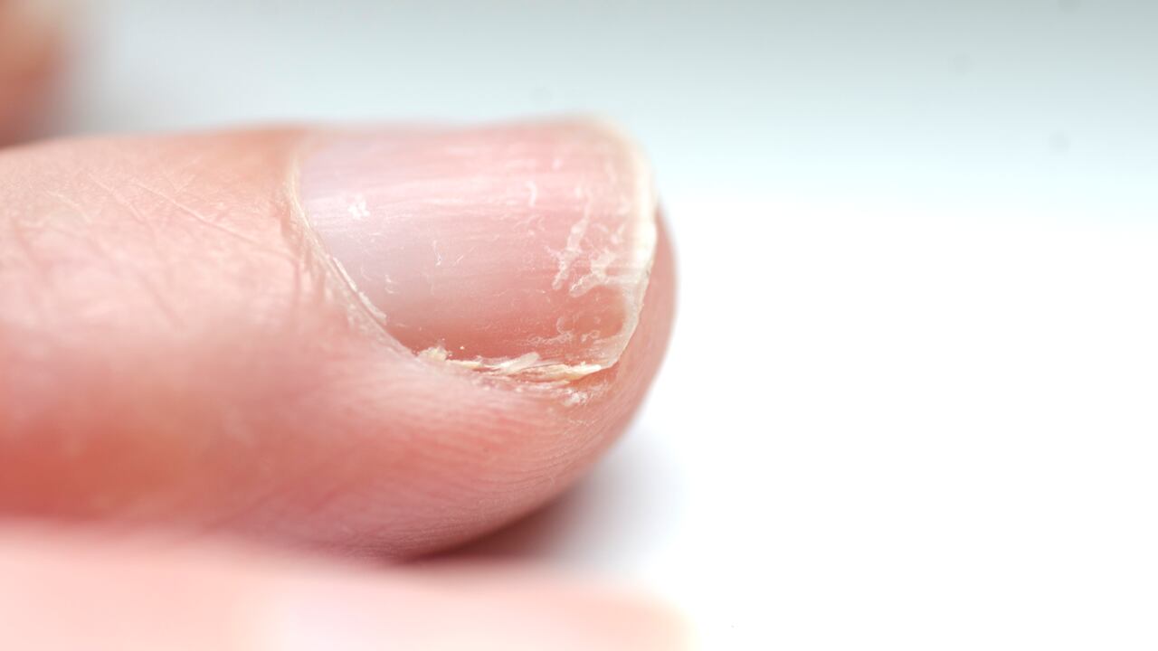 Las uñas quebradizas puede deberse a una mala alimentación.