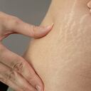 Young woman showing stretch marks on her body