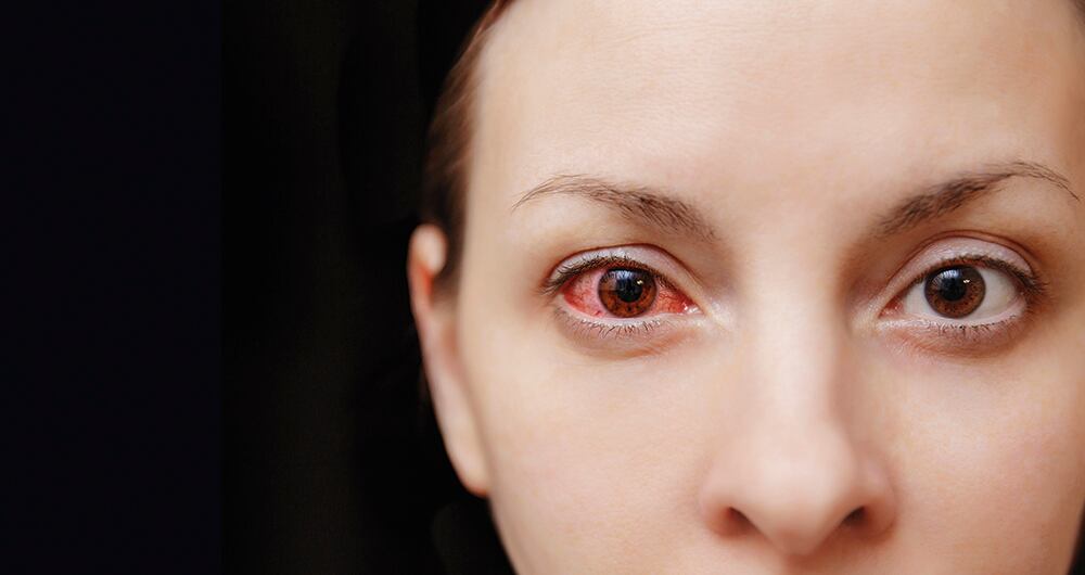 Los ojos pueden infectarse con bacterias, hongos o virus. Las infecciones de los ojos pueden ocurrir en distintas partes del ojo y afectar sólo un ojo o ambos. Dos infecciones comunes del ojo son: Conjuntivitis: también conocida como "ojo rojo".