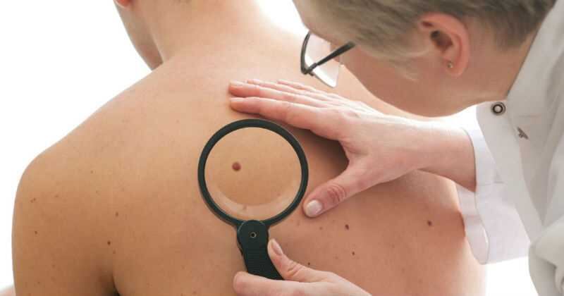 Hay carios tipos de cáncer de piel: si es carcinoma de las células basales, carcinoma de las células escamosas o melanoma, este último es el más grave de los tres por el riesgo que representa al tener la capacidad de hacer metástasis. El melanoma causa el 80% de las muertes por cáncer de piel.