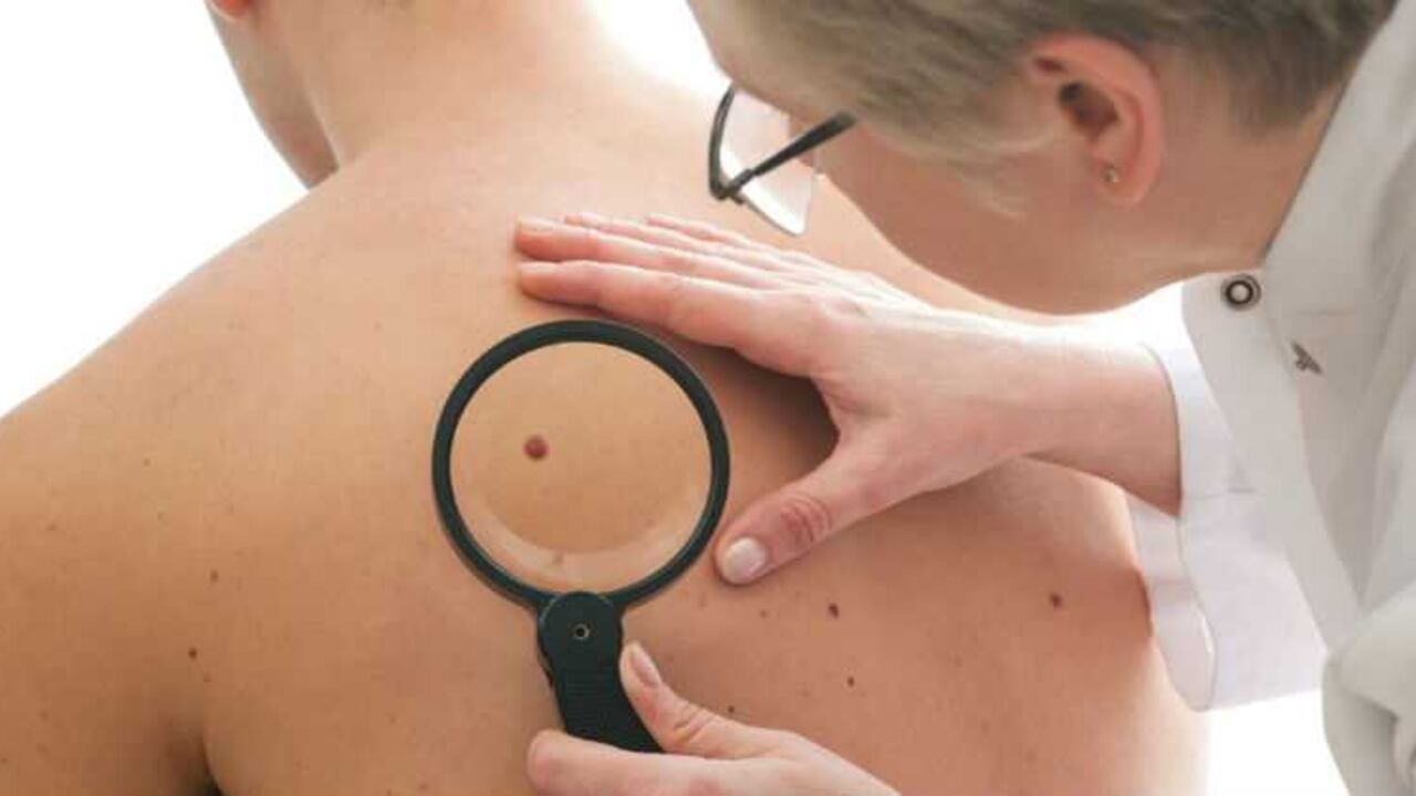 Hay carios tipos de cáncer de piel: si es carcinoma de las células basales, carcinoma de las células escamosas o melanoma, este último es el más grave de los tres por el riesgo que representa al tener la capacidad de hacer metástasis. El melanoma causa el 80% de las muertes por cáncer de piel.