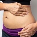 Las estrías suelen aparecer por el aumento y pérdida de peso inmediato, por ejemplo.