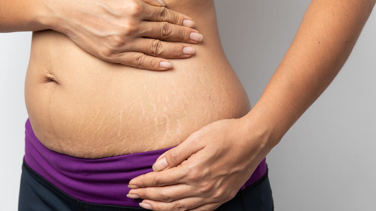 Las estrías suelen aparecer por el aumento y pérdida de peso inmediato, por ejemplo.