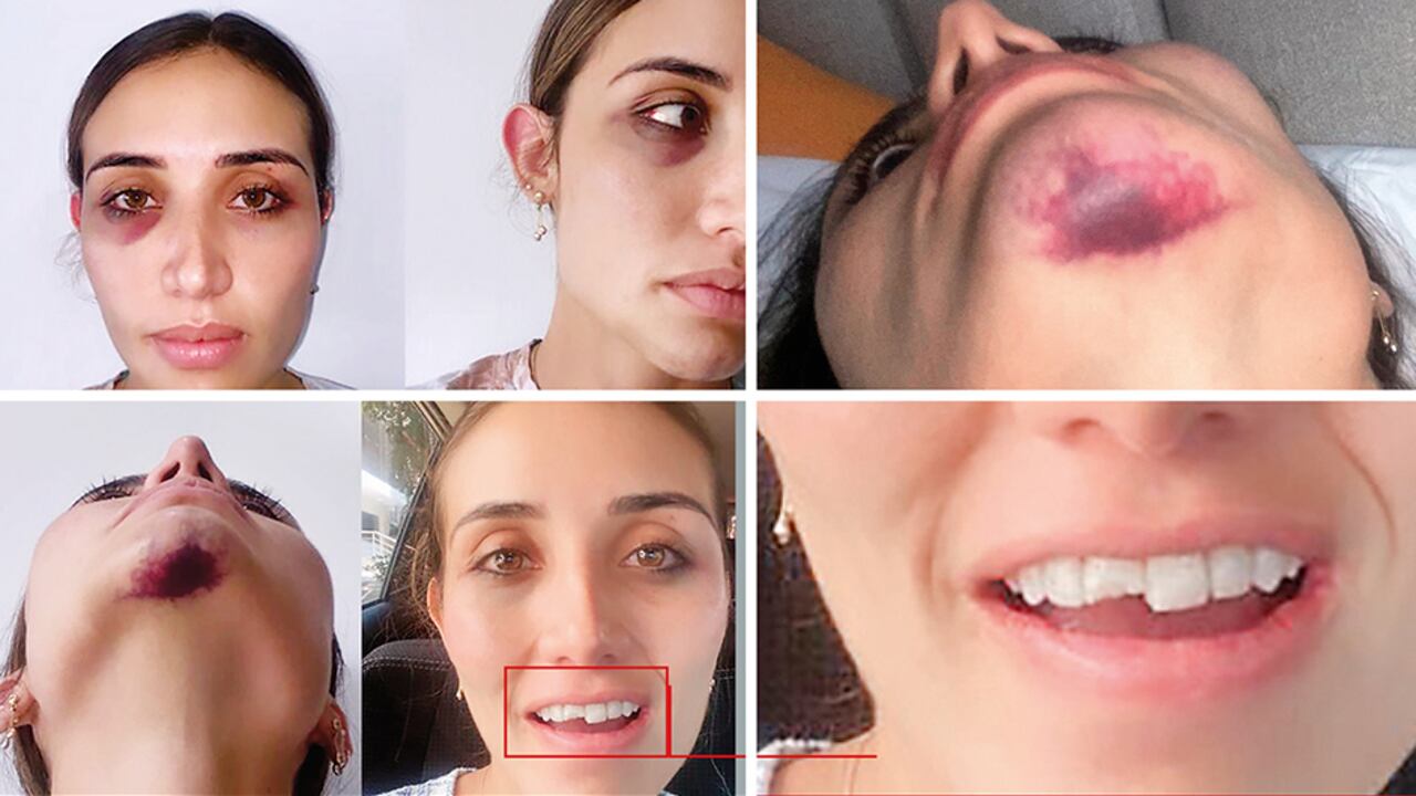 En las imágenes, ella muestra los hematomas en uno de sus ojos y en su barbilla. Se ven claramente varios dientes partidos.