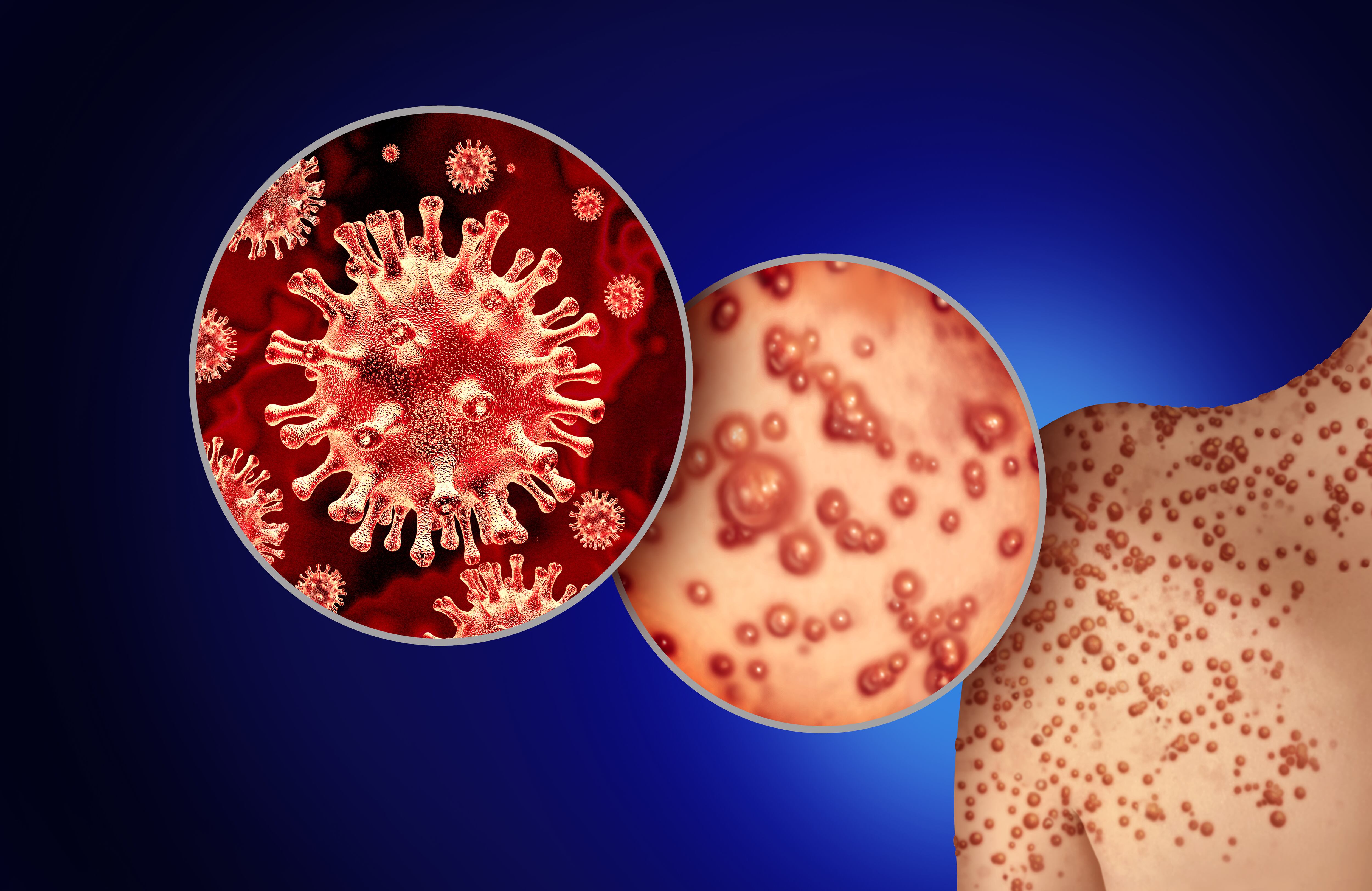 Viruela del mono (Símica)