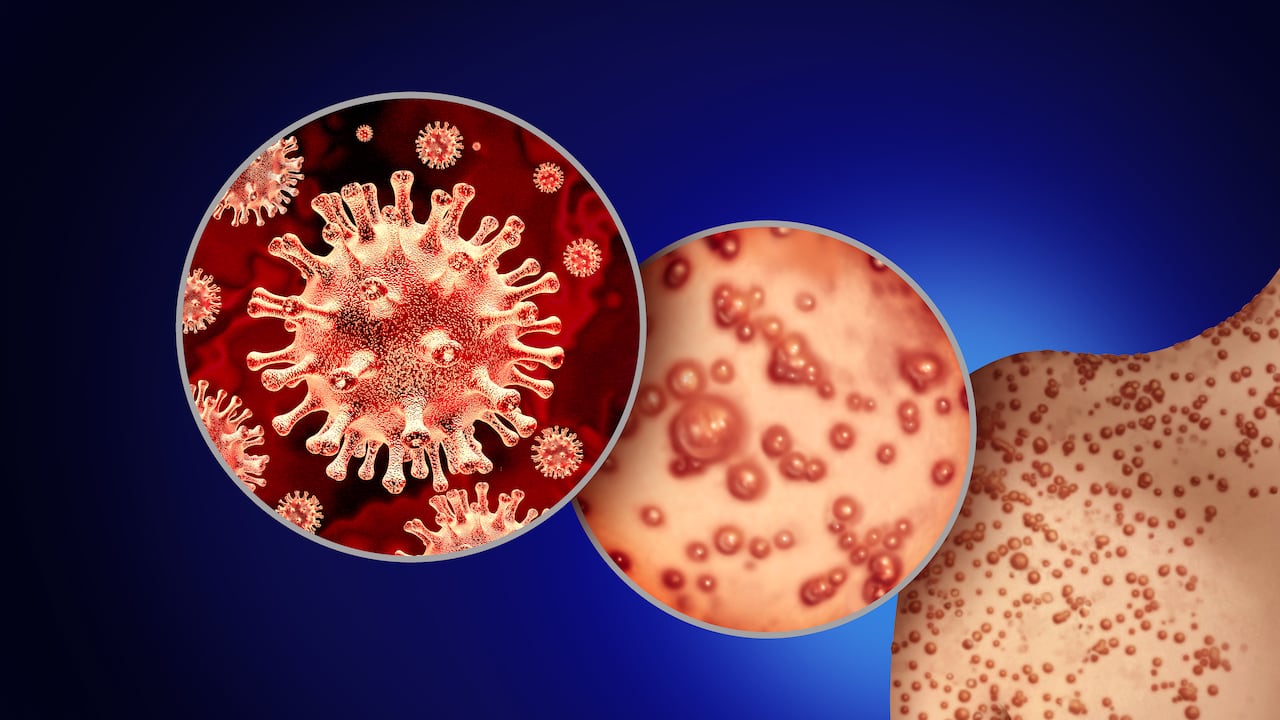 Son más de 5.000 los casos de contagio registrados en todo el mundo.