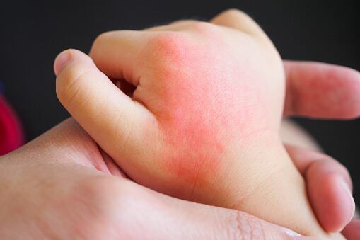 dermatitis bebé