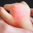 baby hand with skin rash and allergy with red spot cause by mosquito bite