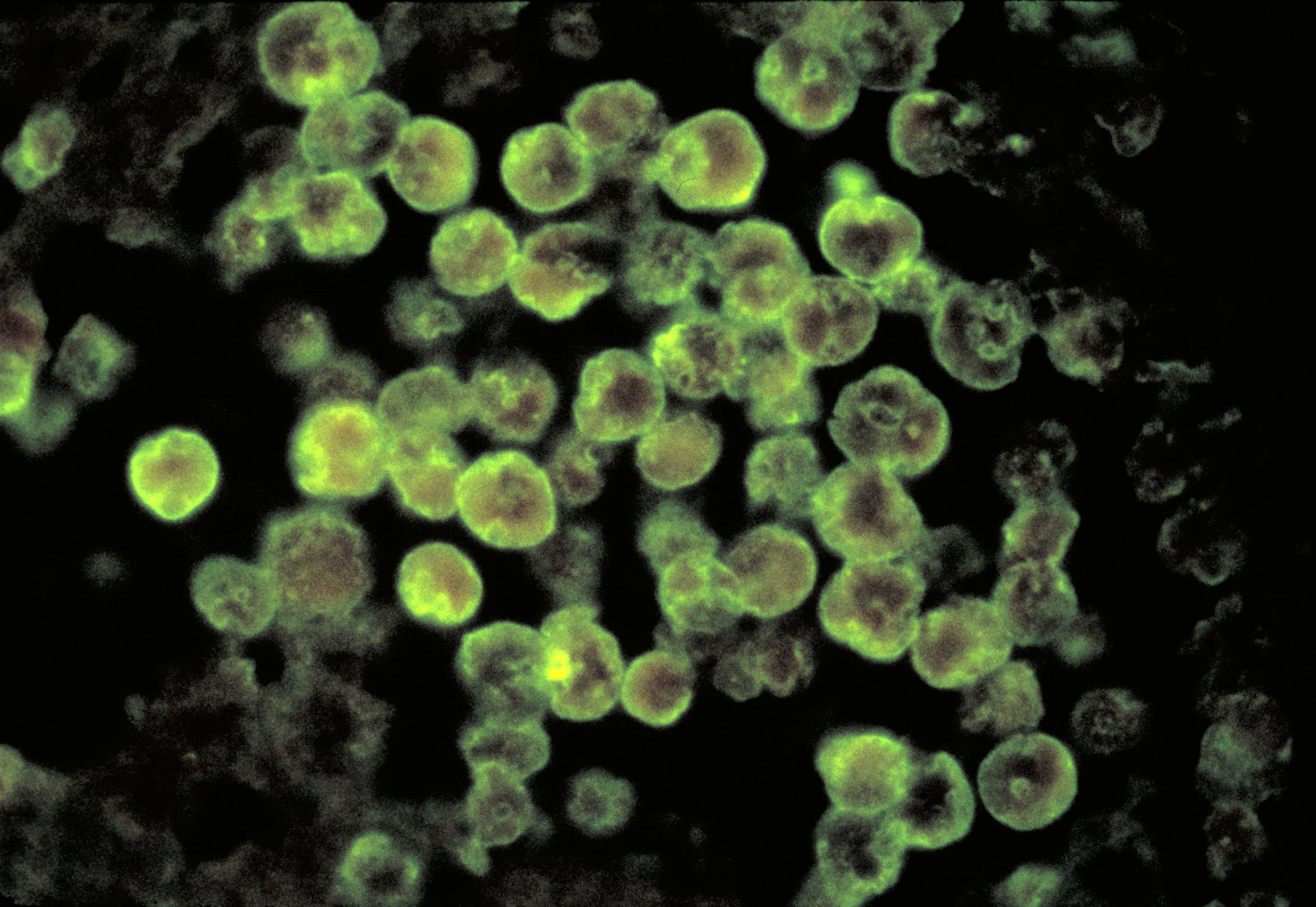 Esta fotomicrografía muestra las características histopatológicas asociadas a un caso de meningoencefalitis amebiana causada por el parásito *Naegleria fowleri*.