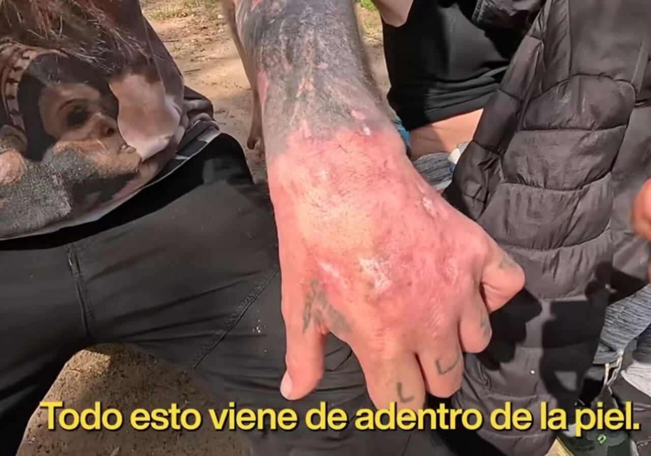 Un entrevistado le muestra a Juan Díaz las quemaduras en la piel que presentó después de consumir fentanilo