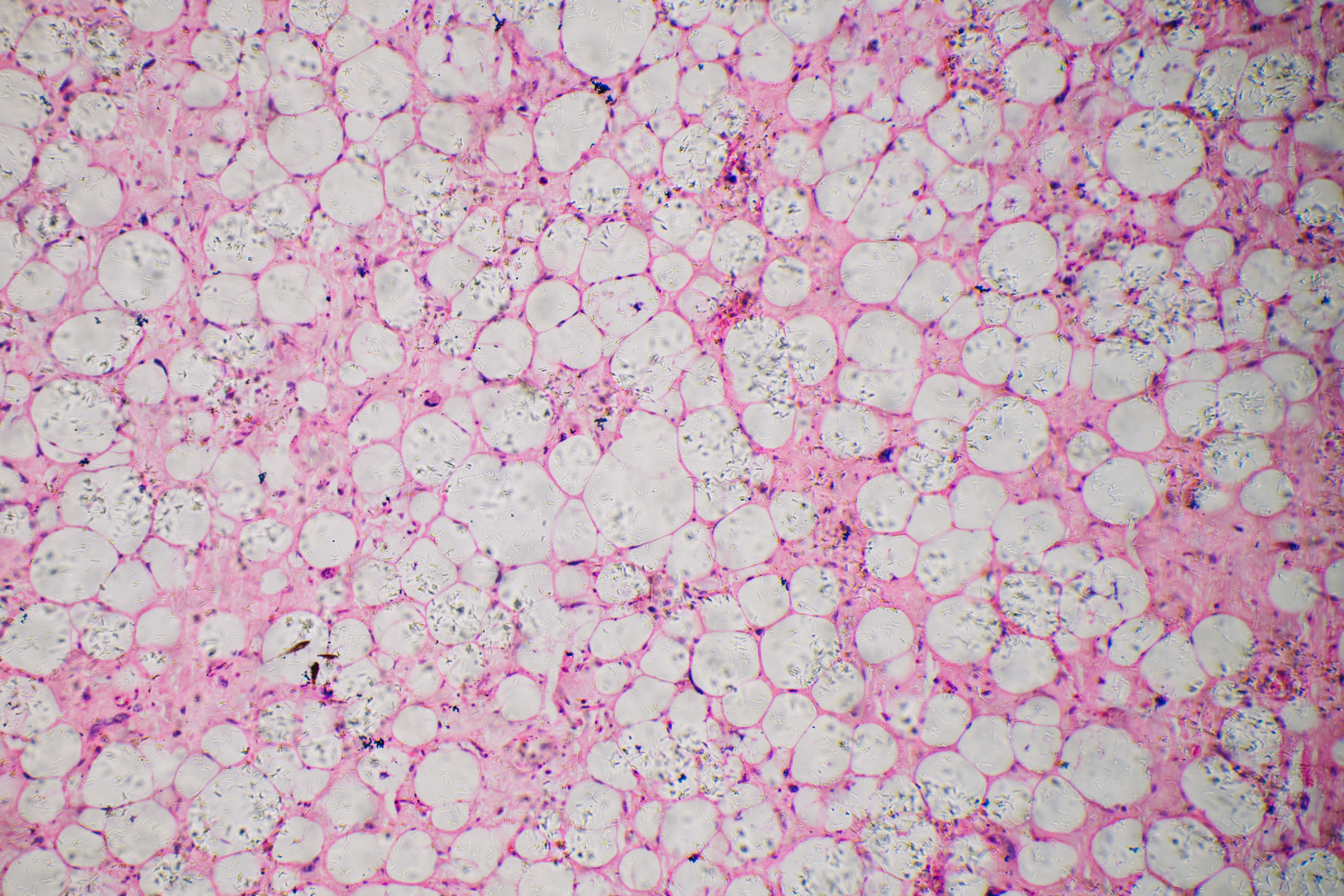 Micrografía de células humanas de liposarcoma.