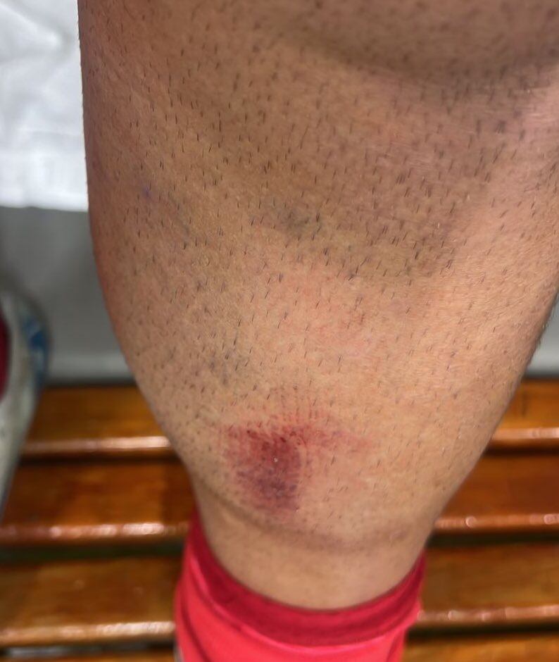 Rodilla inflamada de Holgado.