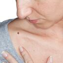 Macro shot of a big skin mole that should be inspected by a dermatologist.