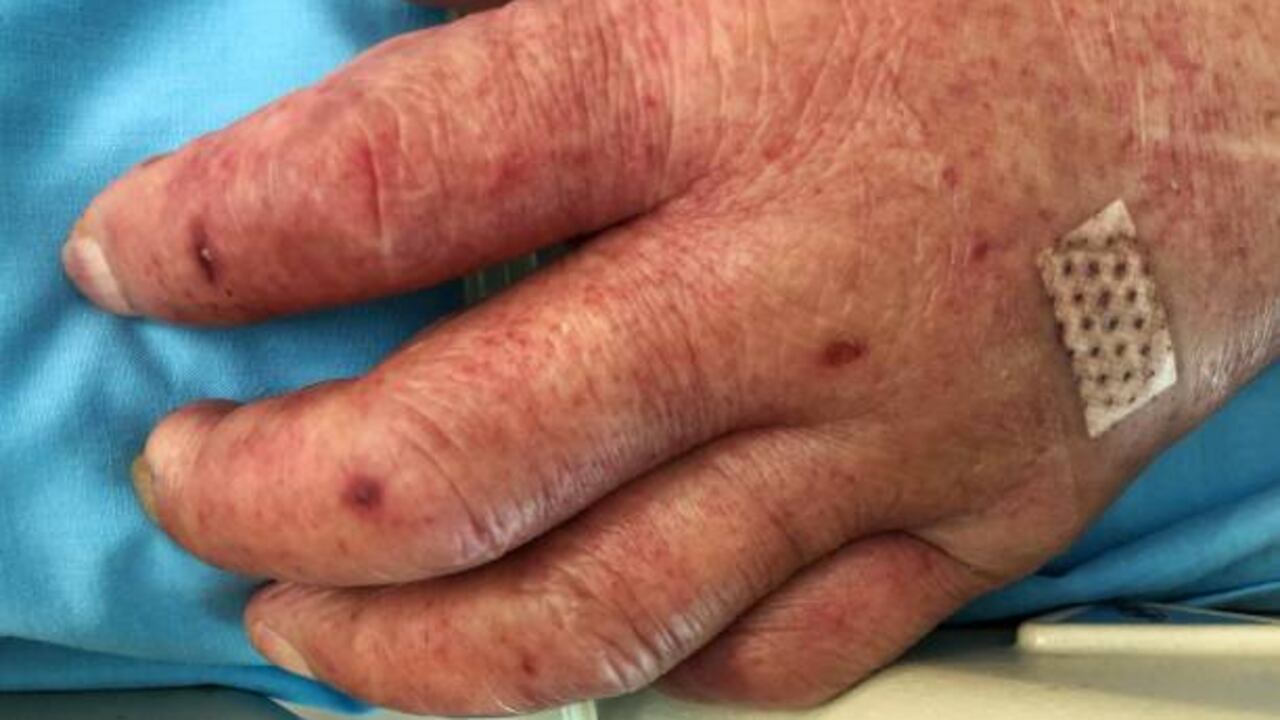 En el departamento se han reportado casi 1.000 casos de dengue.