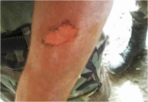 Los exámenes médicos determinaron que las lesiones en varios de los soldados dejarían graves marcas y cicatrices de por vida