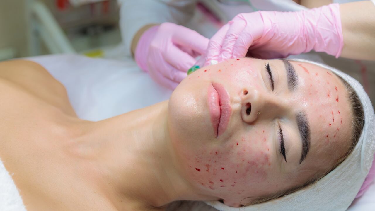 The doctor gives injections of blood plasma into the face of a young girl. Therapeutic procedure, plasmolifting