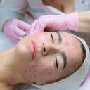 The doctor gives injections of blood plasma into the face of a young girl. Therapeutic procedure, plasmolifting